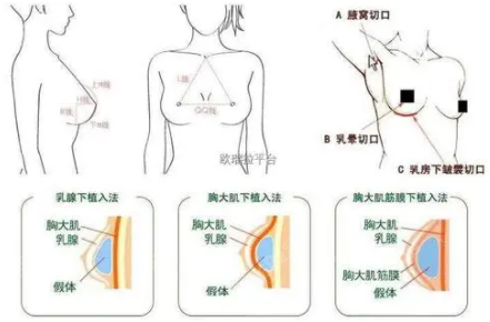 北京假体隆胸取出好的医院有哪些？