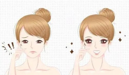 哈尔滨斯美诺双眼皮对比