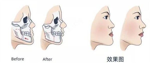 骨性反颌正颌矫正对比图
