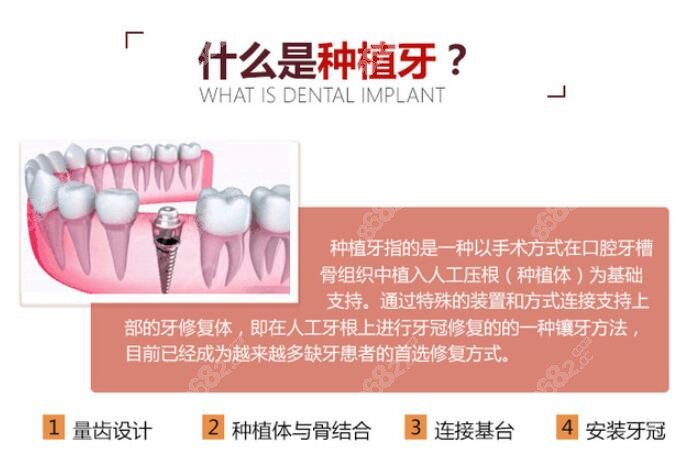 什么是种植牙以及其优点