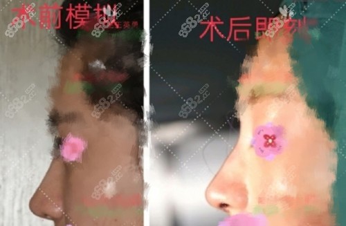 北京煤醫(yī)王英勇醫(yī)生做隆鼻術(shù)前預(yù)知 北京煤醫(yī)王英勇醫(yī)生做隆鼻術(shù)前預(yù)知