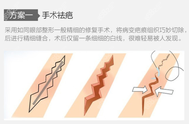 上海时光整形手术祛疤优势