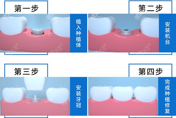 武汉市区口腔医院种植牙价格