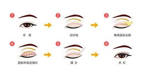 北京英煌整形做眼睛好吗
