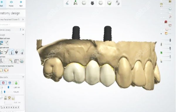 数字化种植牙的术前设计