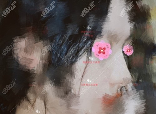 北京煤醫(yī)王英勇醫(yī)生做肋骨鼻修復(fù)術(shù)后 北京煤醫(yī)王英勇醫(yī)生做肋骨鼻修復(fù)術(shù)后