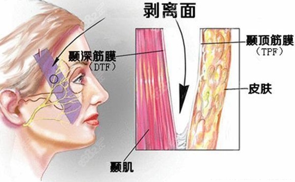 广州荔湾林彪斌做面部拉皮除皱的原理