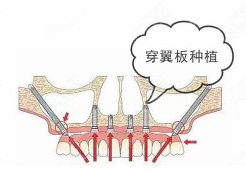 种植牙穿颧穿翼