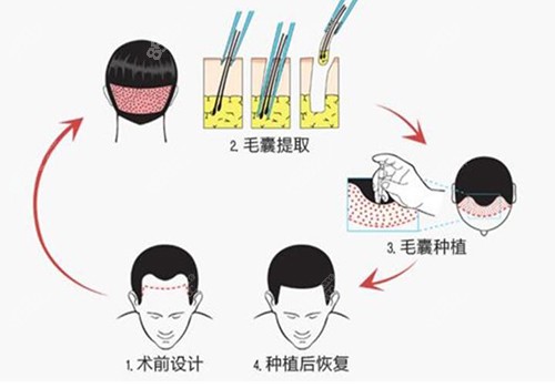 植发流程图