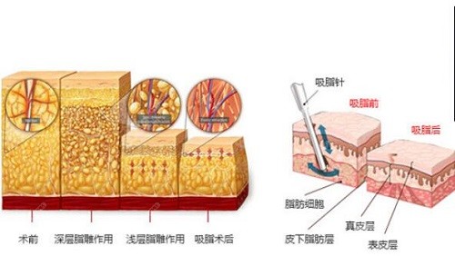 吸脂手术模拟对比图