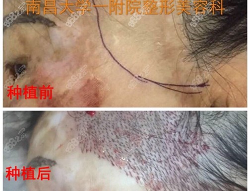 南昌<!--<i data=20240705-sp></i>--><!--<i data=20240705-sp></i>-->院疤痕种植毛发