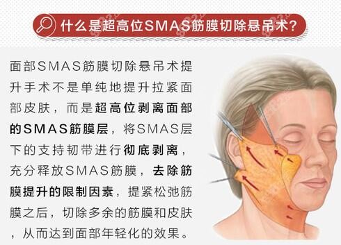 超高位SMAS筋膜切除悬吊术