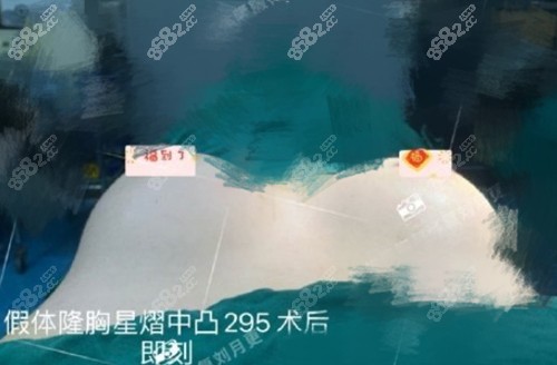 深圳军科刘月更做星熠中凸295cc假体隆胸术后即刻