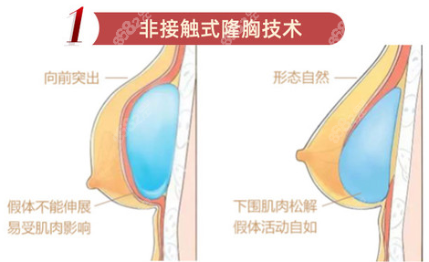 西安画美独有的非接触式复合隆胸术