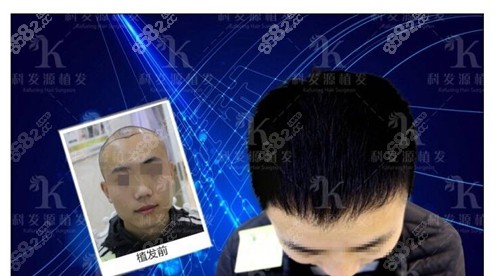南昌科发源植发
