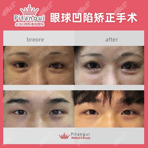 韩国必当归眼球凹陷矫正前后对比