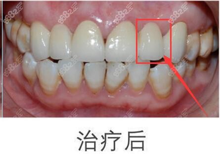 <!--<i data=20240705-sp></i>-->口腔种植牙术后照片