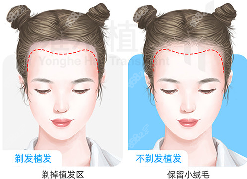 <!--<i data=20240705-sp></i>-->植发不剃发的特色