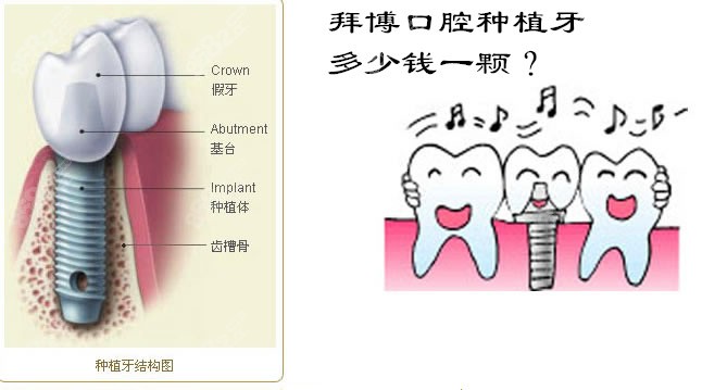 拜博口腔种植一颗牙需要多少钱