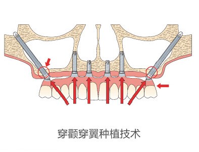长沙中诺易继恩院长可以做穿颧穿翼种植牙