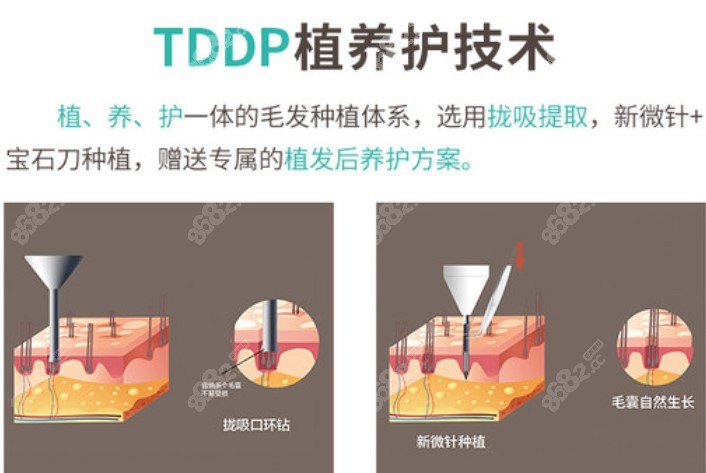 广州<!--<i data=20240705-sp></i>-->植发优势