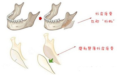 下颌角劈外板图片
