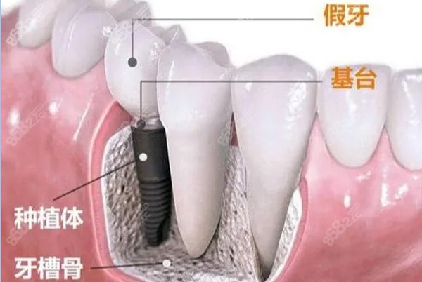 种植牙寿命跟医生技术息息相关