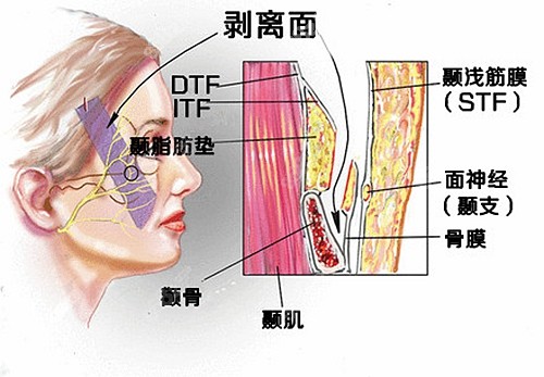 冯立哲的多维拉面部提升痛苦吗