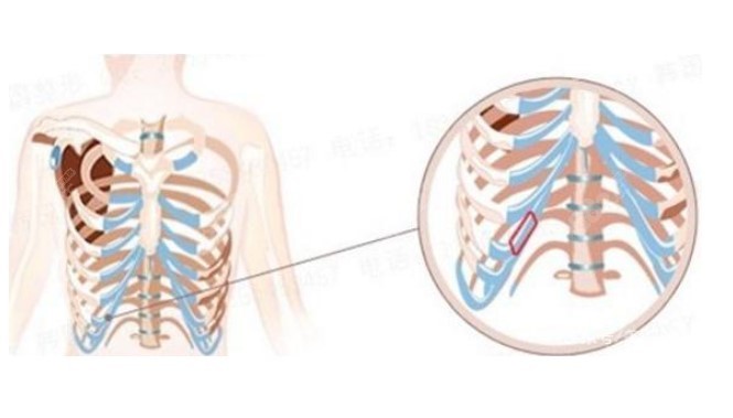 肋软骨隆鼻所取肋骨