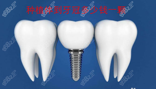 2021年种植体到牙冠多少钱一颗