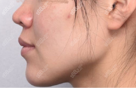 手术后的样子"来看两个北大口腔医院正颌真人图,失败根本不存在的"