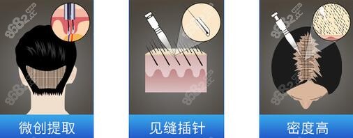 重庆大麦微针植发医院微针头顶加密植发的优势特