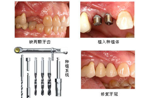 2021种植牙对比图