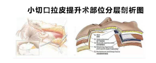 西安拉皮手术哪家好呢？