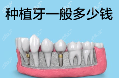 2021年种植牙多少钱一颗