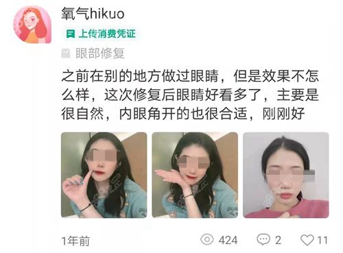 张姣姣双眼皮修复术后反馈