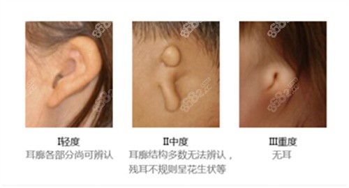 小耳畸形1度2度3度图片