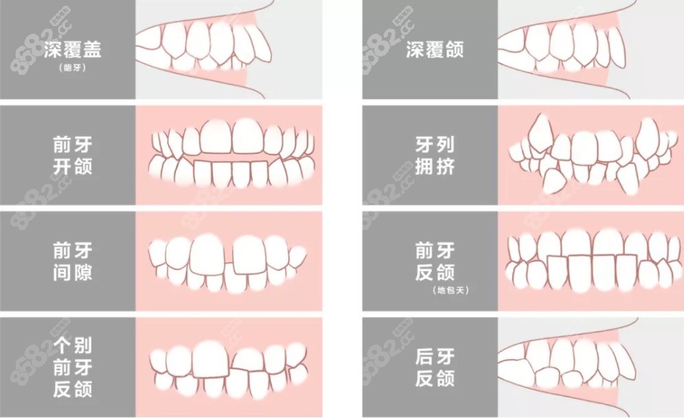 牙齿畸形的类型有哪些.jpg