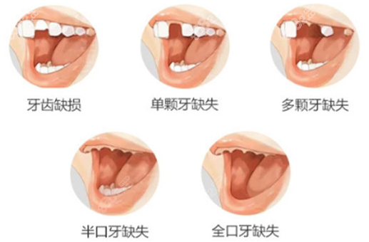 常见牙齿缺失问题