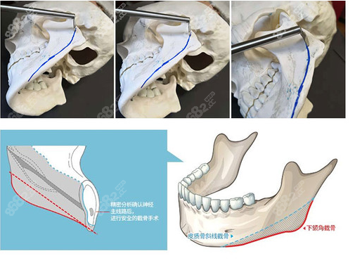 廣州磨骨哪個醫(yī)生好呢？
