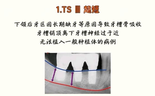 韩国奥齿泰纯钛种植体ts特点