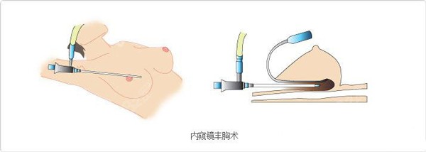 赵敬国做内窥镜隆胸的原理