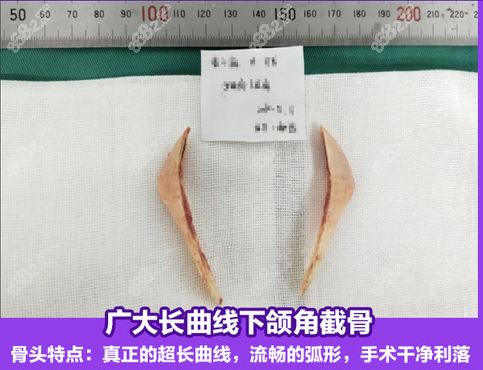 柳超柳超截骨圖