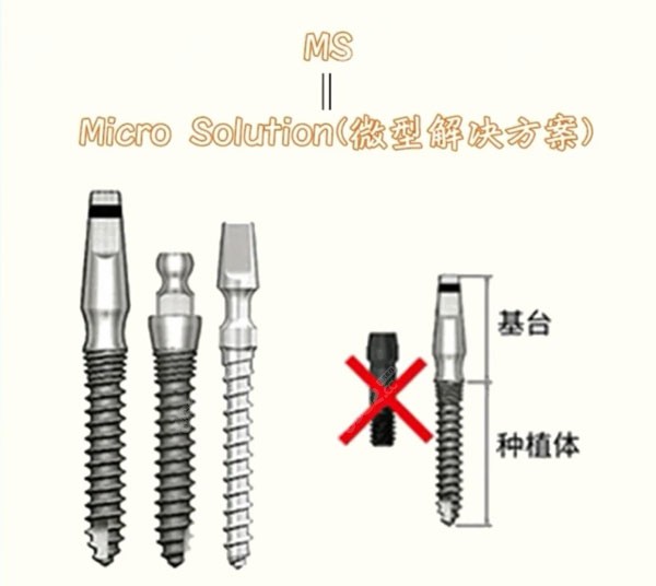 韩国奥齿泰纯钛种植体ms特点