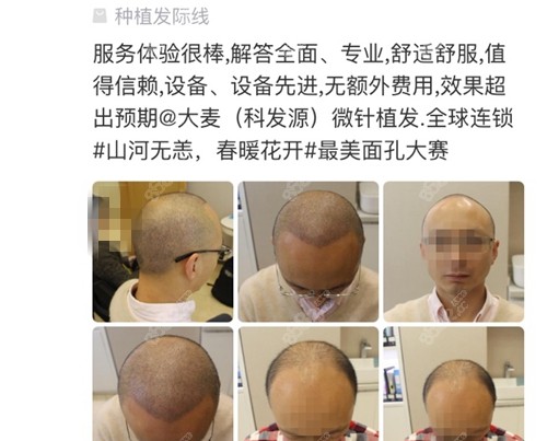 网友在成都大麦微针植发口碑点评