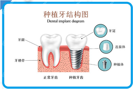 <!--<i data=20240705-sp></i>-->口腔种植牙