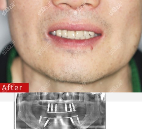 武漢德韓口腔種植牙