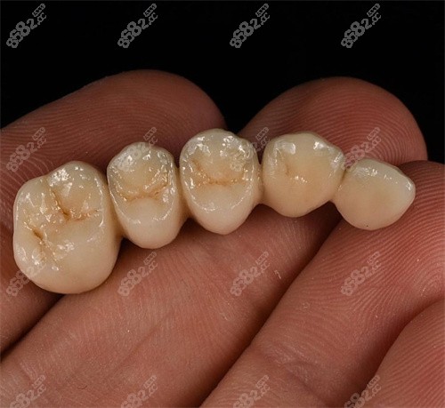 靖江戴红军口腔诊所全瓷贴面