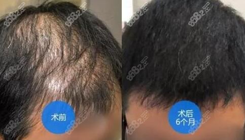 植发术前术后6个月对比照