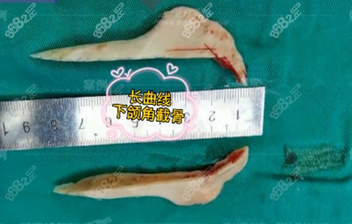 邱立東做下頜角的費(fèi)用 邱立東做下頜角的費(fèi)用